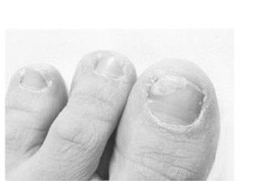 TERBINAFIN-1A Pharma Nagelll.g.Nagelpilz 78,22mg/ml, 6.6 ml