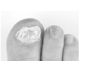 TERBINAFIN-1A Pharma Nagelll.g.Nagelpilz 78,22mg/ml, 6.6 ml